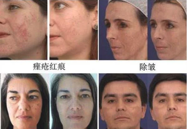 做脉冲光去痘印治疗效果怎么样？效果保持时间多久？