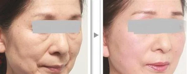 做射频紧肤多少钱