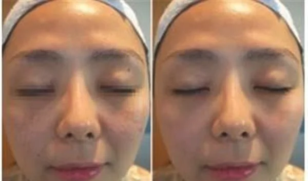 微晶磨皮去鱼尾纹手术术后护理？