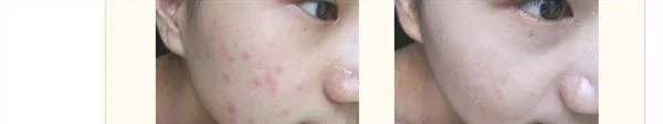 做果酸换肤袪痘疤多少钱