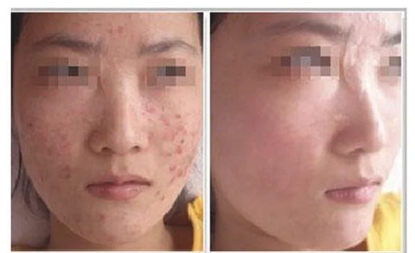 光子祛痘优点有哪些?