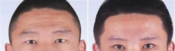 做玻尿酸去眉间纹治疗效果怎么样？效果保持时间多久？