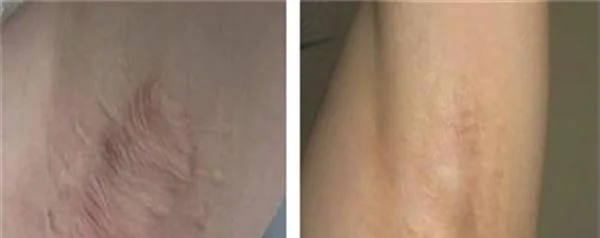 做冷冻法去腋臭治疗效果怎么样？效果保持时间多久？