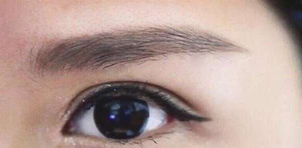 E光去鱼尾纹手术安全吗？