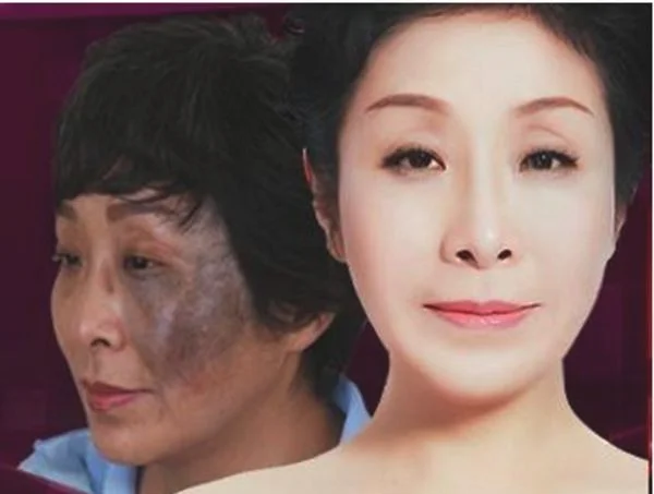 做去太田痣失败修复治疗效果怎么样？效果保持时间多久？