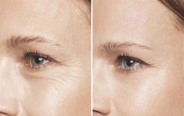 做玻尿酸去鱼尾纹价格是多少