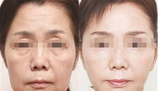 做激光美白价格是多少