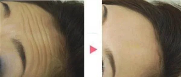 自体脂肪去抬头纹要多少钱？