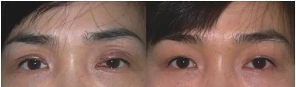 做眼睑疤痕修复价格
