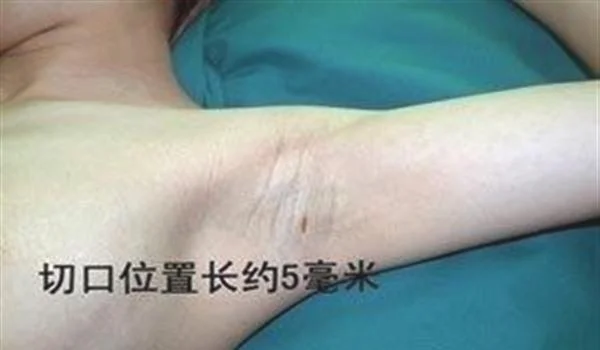 做切除去狐臭手术多少钱？