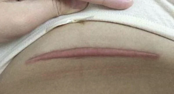 做剖腹产疤痕修复手术注意事项是什么？