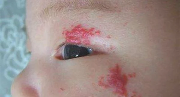 做治疗血管瘤手术注意事项是什么？