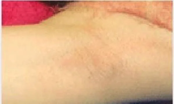 做切除法去腋臭价格要多少