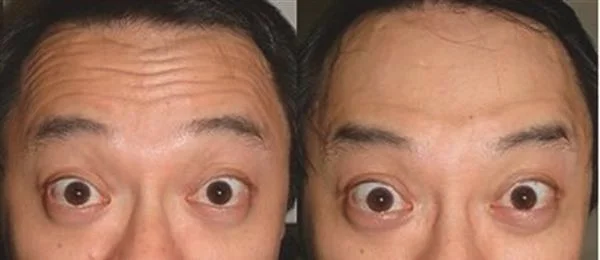 激光去除抬头纹维持时间是多久?