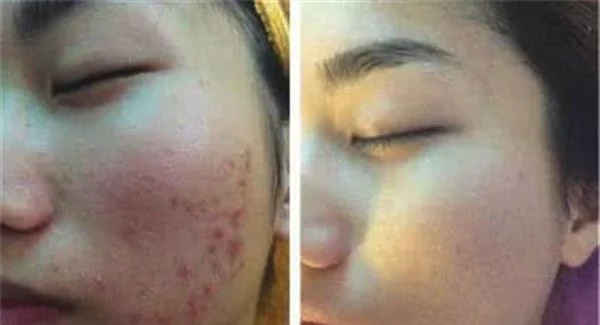 做自体脂肪去痘疤治疗效果怎么样？效果保持时间多久？