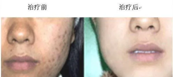 做治疗痤疮价格贵不贵