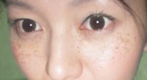 做射频祛斑手术注意事项是什么？