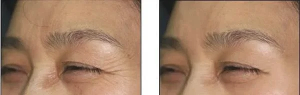 做微晶磨皮去鱼尾纹价格贵不贵