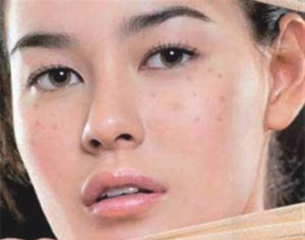 做去色斑多少钱