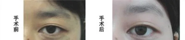 冷冻去除太田痣手术安全吗？