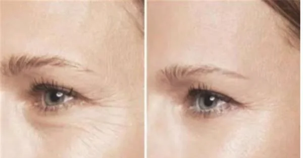 做激光除鱼尾纹价格多少钱