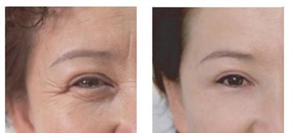 爱贝芙去鱼尾纹优点是什么？