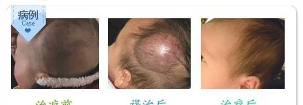 光子治疗血管瘤手术效果好不好？