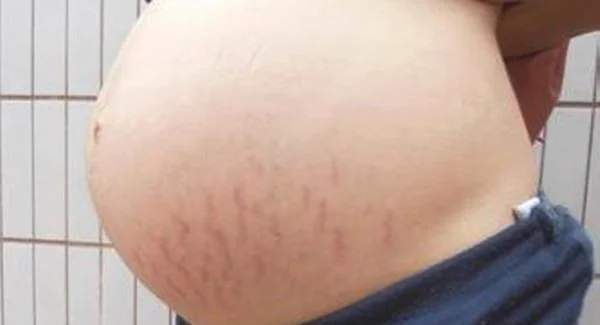 做光子去妊娠纹价格是多少