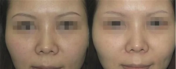 E光去黄褐斑手术术后护理？