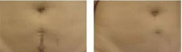 剖腹产疤痕修复效果好不好？