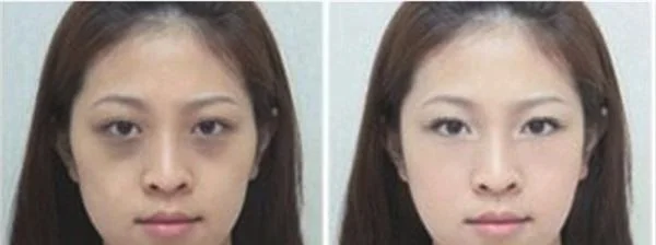 做E光治疗太田痣价格