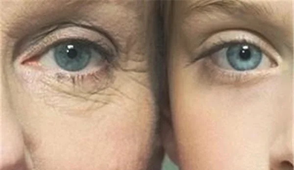 做去眼角细纹价格