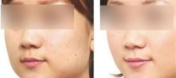 做黑脸娃娃去痘印手术多少钱？