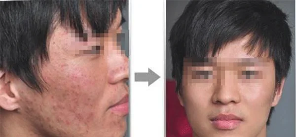 做袪青春痘价格