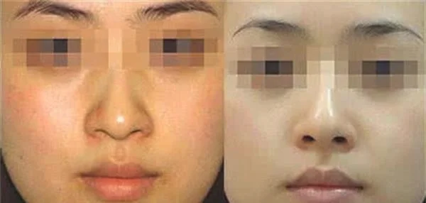 做激光美白治疗效果怎么样？效果保持时间多久？