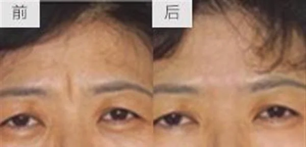 做自体脂肪去眉间纹多少钱