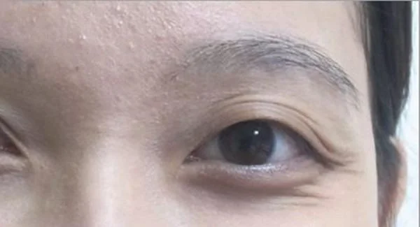 做自体脂肪去鱼尾纹手术注意事项是什么?