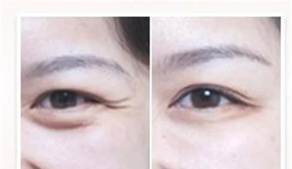 自体脂肪去鱼尾纹要多少钱？