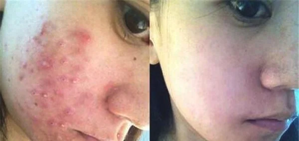 做激光去青春痘价格