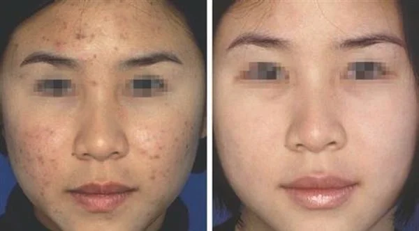 光子去痘印手术安全吗?