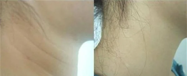 做去颈纹治疗效果怎么样？效果保持时间多久？