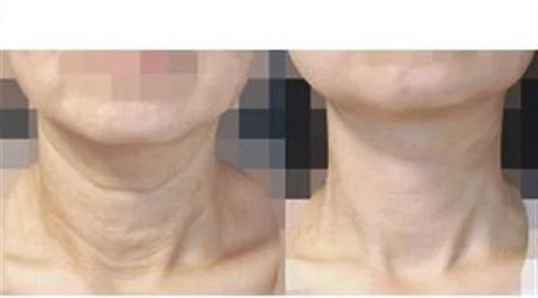 做自体脂肪除颈纹多少钱