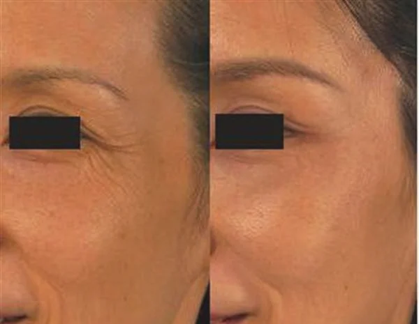 做额颞部除皱去鱼尾纹手术多少钱?