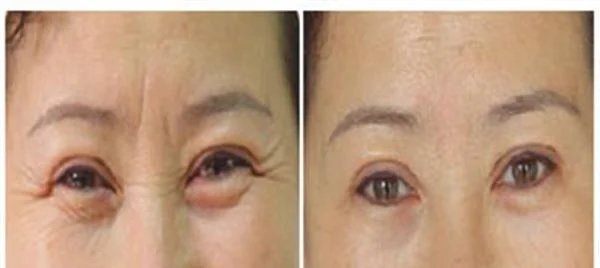 做玻尿酸去眼角细纹费用多少钱