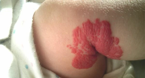 做光子治疗血管瘤手术注意事项是什么?