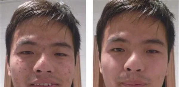 做剥脱治疗太田痣手术多少钱？