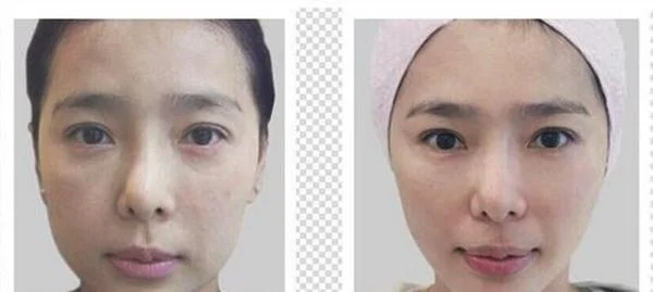 做黑脸娃娃美白手术多少钱？