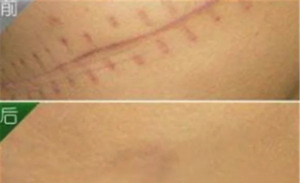 手术疤痕修复恢复需要注意什么?