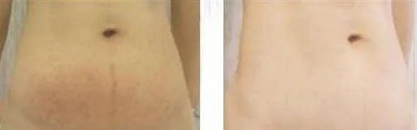 做激光去妊娠纹费用大概需要多少
