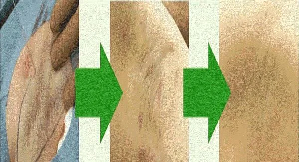 做切除法去腋臭价格贵吗